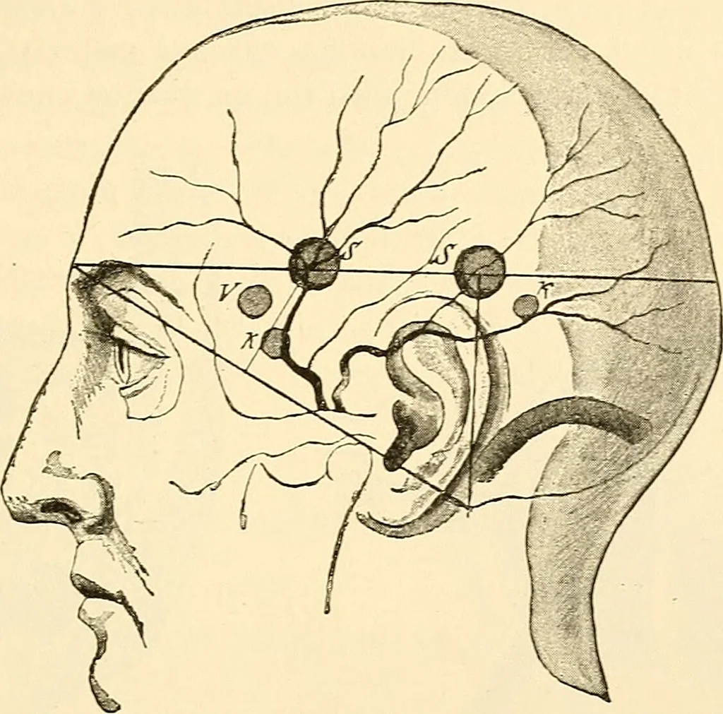 An illustration from Surgical technic; a text-book on operative surgery / by Fr. von Esmarch ... and E. Kowalzig ... translated by Professor Ludwig H. Grau ... and Willam N. Sullivan ... edited by Nicholas Senn ... With fourteen hundred and ninety-seven illustrations and fifteen colored plates., 1901, leaf 549
