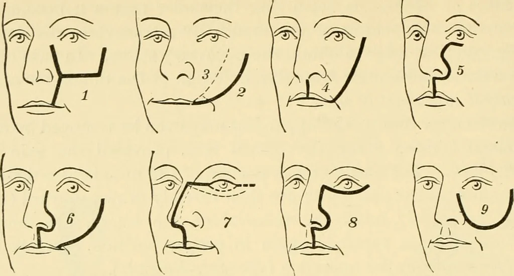 An illustration from Surgical technic; a text-book on operative surgery / by Fr. von Esmarch ... and E. Kowalzig ... translated by Professor Ludwig H. Grau ... and Willam N. Sullivan ... edited by Nicholas Senn ... With fourteen hundred and ninety-seven illustrations and fifteen colored plates., 1901, leaf 554