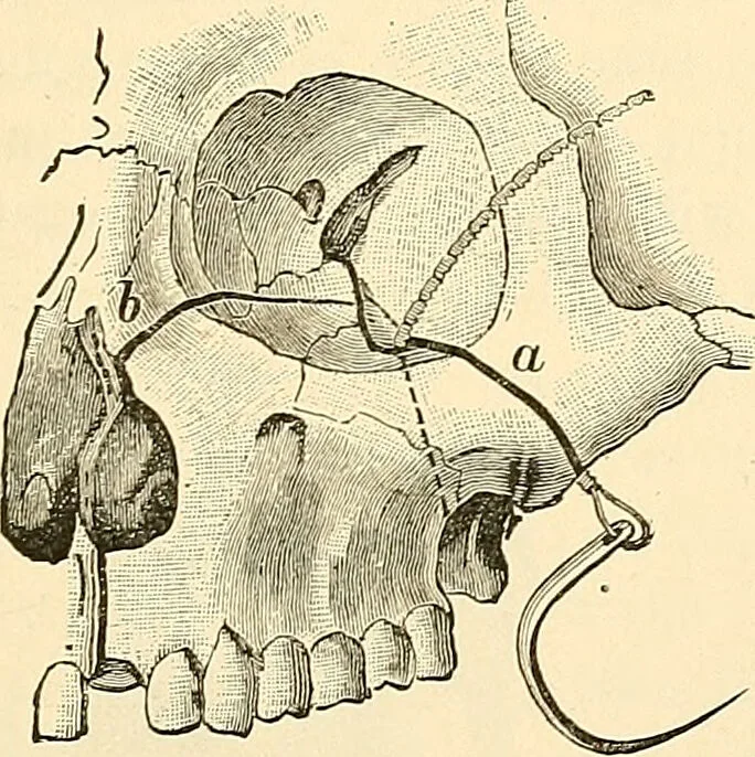 An illustration from Surgical technic; a text-book on operative surgery / by Fr. von Esmarch ... and E. Kowalzig ... translated by Professor Ludwig H. Grau ... and Willam N. Sullivan ... edited by Nicholas Senn ... With fourteen hundred and ninety-seven illustrations and fifteen colored plates., 1901, leaf 555
