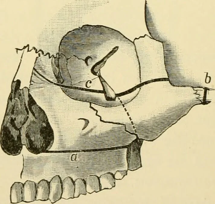 An illustration from Surgical technic; a text-book on operative surgery / by Fr. von Esmarch ... and E. Kowalzig ... translated by Professor Ludwig H. Grau ... and Willam N. Sullivan ... edited by Nicholas Senn ... With fourteen hundred and ninety-seven illustrations and fifteen colored plates., 1901, leaf 558