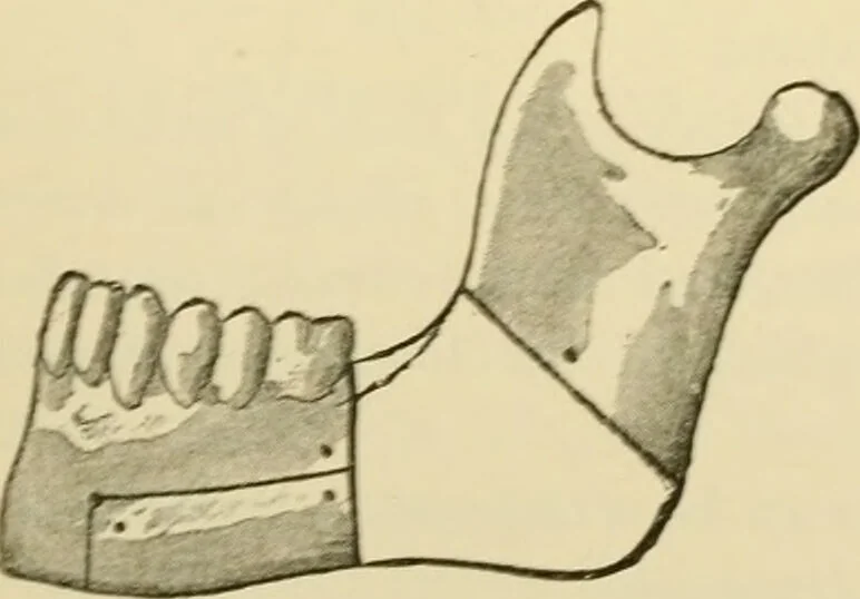 An illustration from Surgical technic; a text-book on operative surgery / by Fr. von Esmarch ... and E. Kowalzig ... translated by Professor Ludwig H. Grau ... and Willam N. Sullivan ... edited by Nicholas Senn ... With fourteen hundred and ninety-seven illustrations and fifteen colored plates., 1901, leaf 566
