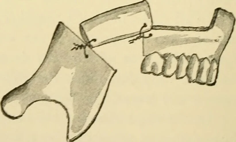 An illustration from Surgical technic; a text-book on operative surgery / by Fr. von Esmarch ... and E. Kowalzig ... translated by Professor Ludwig H. Grau ... and Willam N. Sullivan ... edited by Nicholas Senn ... With fourteen hundred and ninety-seven illustrations and fifteen colored plates., 1901, leaf 566
