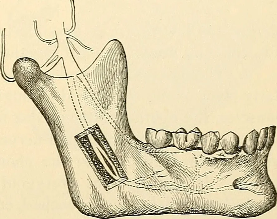 An illustration from Surgical technic; a text-book on operative surgery / by Fr. von Esmarch ... and E. Kowalzig ... translated by Professor Ludwig H. Grau ... and Willam N. Sullivan ... edited by Nicholas Senn ... With fourteen hundred and ninety-seven illustrations and fifteen colored plates., 1901, leaf 577