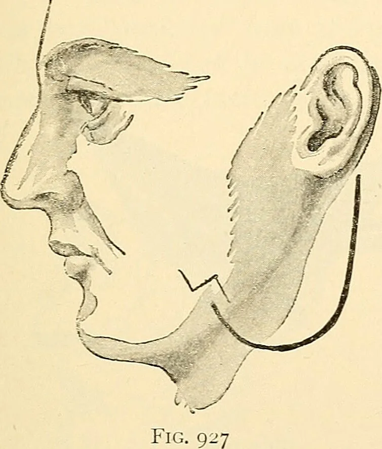 An illustration from Surgical technic; a text-book on operative surgery / by Fr. von Esmarch ... and E. Kowalzig ... translated by Professor Ludwig H. Grau ... and Willam N. Sullivan ... edited by Nicholas Senn ... With fourteen hundred and ninety-seven illustrations and fifteen colored plates., 1901, leaf 579
