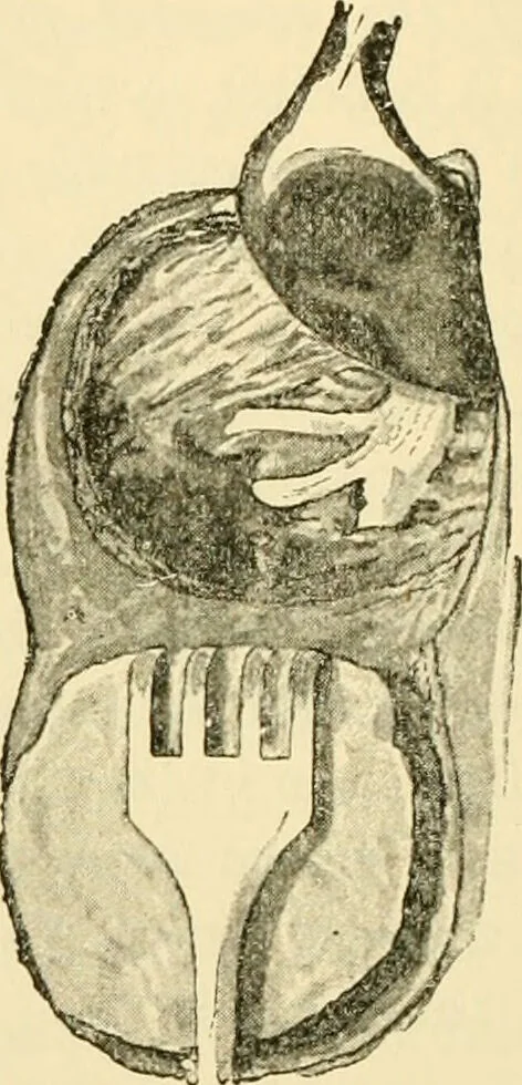 An illustration from Surgical technic; a text-book on operative surgery / by Fr. von Esmarch ... and E. Kowalzig ... translated by Professor Ludwig H. Grau ... and Willam N. Sullivan ... edited by Nicholas Senn ... With fourteen hundred and ninety-seven illustrations and fifteen colored plates., 1901, leaf 584