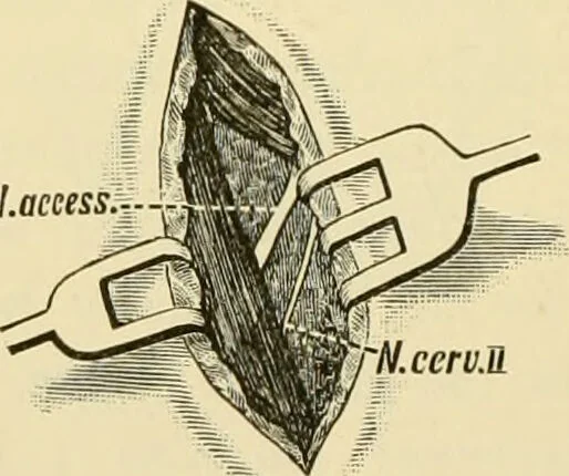 An illustration from Surgical technic; a text-book on operative surgery / by Fr. von Esmarch ... and E. Kowalzig ... translated by Professor Ludwig H. Grau ... and Willam N. Sullivan ... edited by Nicholas Senn ... With fourteen hundred and ninety-seven illustrations and fifteen colored plates., 1901, leaf 586