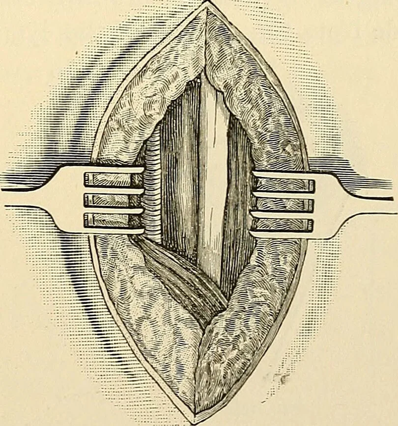 An illustration from Surgical technic; a text-book on operative surgery / by Fr. von Esmarch ... and E. Kowalzig ... translated by Professor Ludwig H. Grau ... and Willam N. Sullivan ... edited by Nicholas Senn ... With fourteen hundred and ninety-seven illustrations and fifteen colored plates., 1901, leaf 589