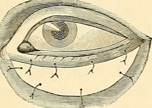 An illustration from Surgical technic; a text-book on operative surgery / by Fr. von Esmarch ... and E. Kowalzig ... translated by Professor Ludwig H. Grau ... and Willam N. Sullivan ... edited by Nicholas Senn ... With fourteen hundred and ninety-seven illustrations and fifteen colored plates., 1901, leaf 591