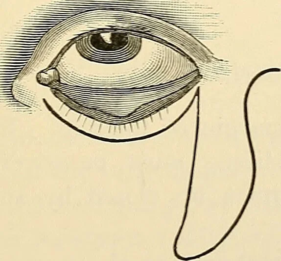 An illustration from Surgical technic; a text-book on operative surgery / by Fr. von Esmarch ... and E. Kowalzig ... translated by Professor Ludwig H. Grau ... and Willam N. Sullivan ... edited by Nicholas Senn ... With fourteen hundred and ninety-seven illustrations and fifteen colored plates., 1901, leaf 591
