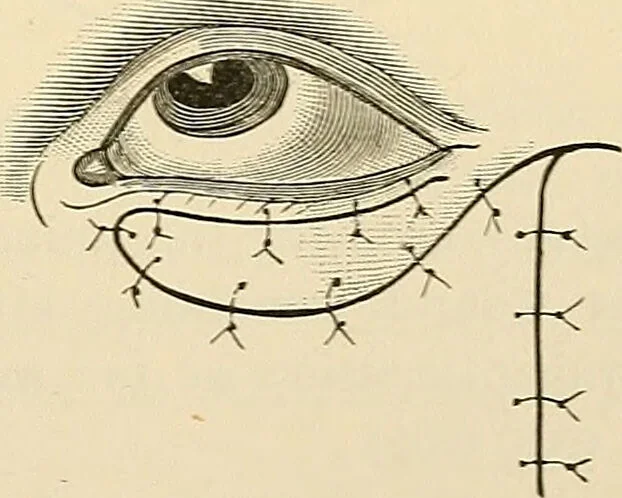 An illustration from Surgical technic; a text-book on operative surgery / by Fr. von Esmarch ... and E. Kowalzig ... translated by Professor Ludwig H. Grau ... and Willam N. Sullivan ... edited by Nicholas Senn ... With fourteen hundred and ninety-seven illustrations and fifteen colored plates., 1901, leaf 591
