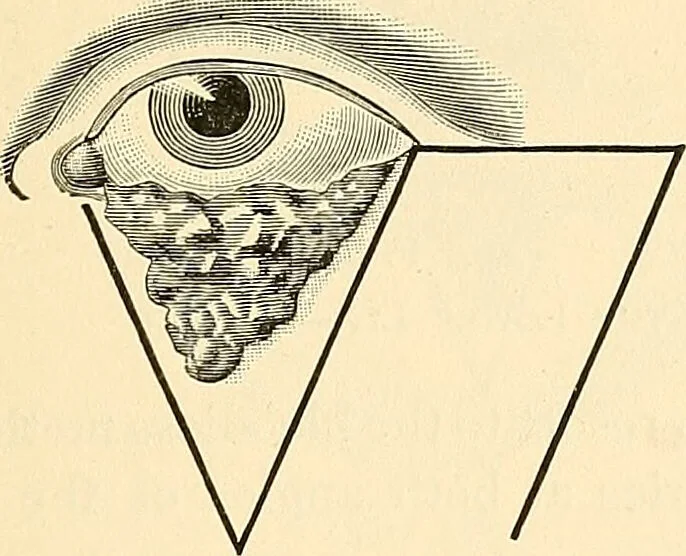 An illustration from Surgical technic; a text-book on operative surgery / by Fr. von Esmarch ... and E. Kowalzig ... translated by Professor Ludwig H. Grau ... and Willam N. Sullivan ... edited by Nicholas Senn ... With fourteen hundred and ninety-seven illustrations and fifteen colored plates., 1901, leaf 593