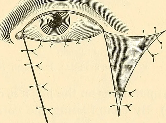 An illustration from Surgical technic; a text-book on operative surgery / by Fr. von Esmarch ... and E. Kowalzig ... translated by Professor Ludwig H. Grau ... and Willam N. Sullivan ... edited by Nicholas Senn ... With fourteen hundred and ninety-seven illustrations and fifteen colored plates., 1901, leaf 593