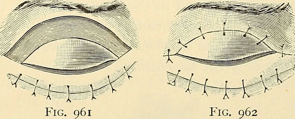 An illustration from Surgical technic; a text-book on operative surgery / by Fr. von Esmarch ... and E. Kowalzig ... translated by Professor Ludwig H. Grau ... and Willam N. Sullivan ... edited by Nicholas Senn ... With fourteen hundred and ninety-seven illustrations and fifteen colored plates., 1901, leaf 593