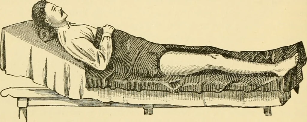An illustration from Surgical technic; a text-book on operative surgery / by Fr. von Esmarch ... and E. Kowalzig ... translated by Professor Ludwig H. Grau ... and Willam N. Sullivan ... edited by Nicholas Senn ... With fourteen hundred and ninety-seven illustrations and fifteen colored plates., 1901, leaf 60