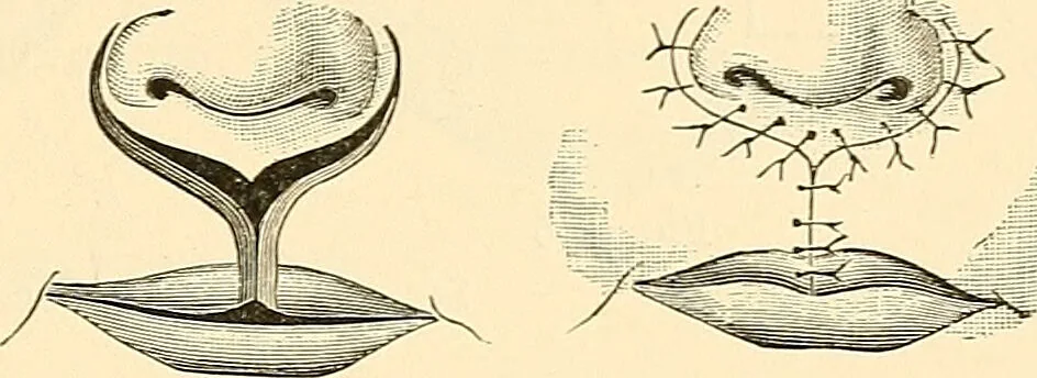 An illustration from Surgical technic; a text-book on operative surgery / by Fr. von Esmarch ... and E. Kowalzig ... translated by Professor Ludwig H. Grau ... and Willam N. Sullivan ... edited by Nicholas Senn ... With fourteen hundred and ninety-seven illustrations and fifteen colored plates., 1901, leaf 601