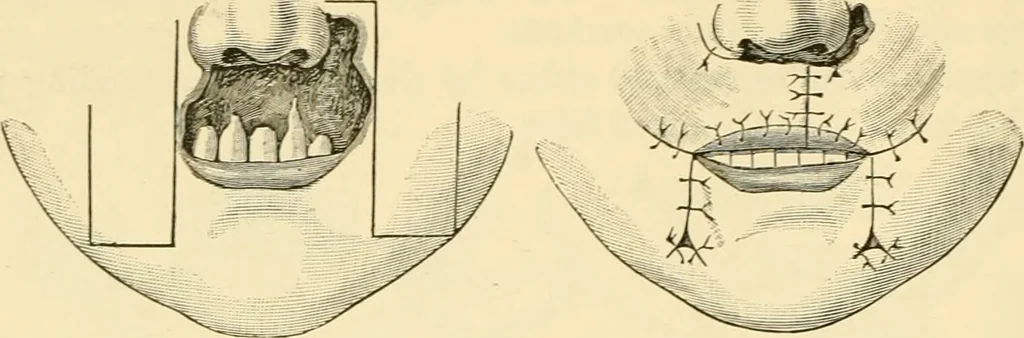 An illustration from Surgical technic; a text-book on operative surgery / by Fr. von Esmarch ... and E. Kowalzig ... translated by Professor Ludwig H. Grau ... and Willam N. Sullivan ... edited by Nicholas Senn ... With fourteen hundred and ninety-seven illustrations and fifteen colored plates., 1901, leaf 602