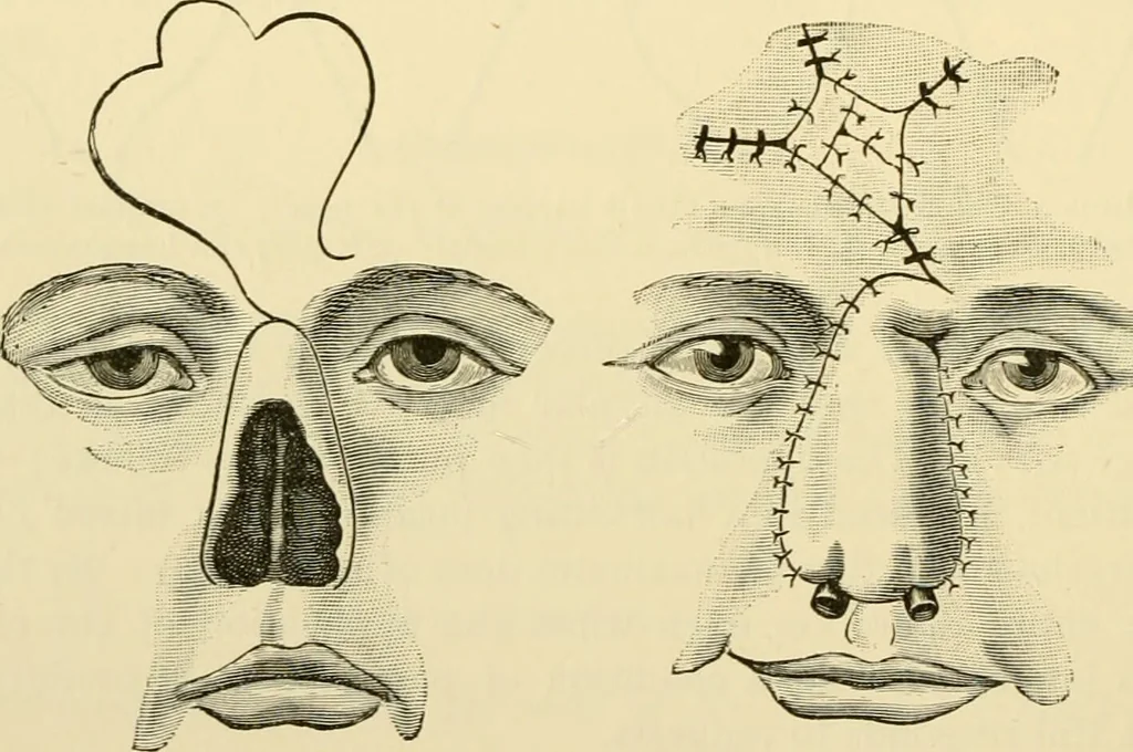 An illustration from Surgical technic; a text-book on operative surgery / by Fr. von Esmarch ... and E. Kowalzig ... translated by Professor Ludwig H. Grau ... and Willam N. Sullivan ... edited by Nicholas Senn ... With fourteen hundred and ninety-seven illustrations and fifteen colored plates., 1901, leaf 608