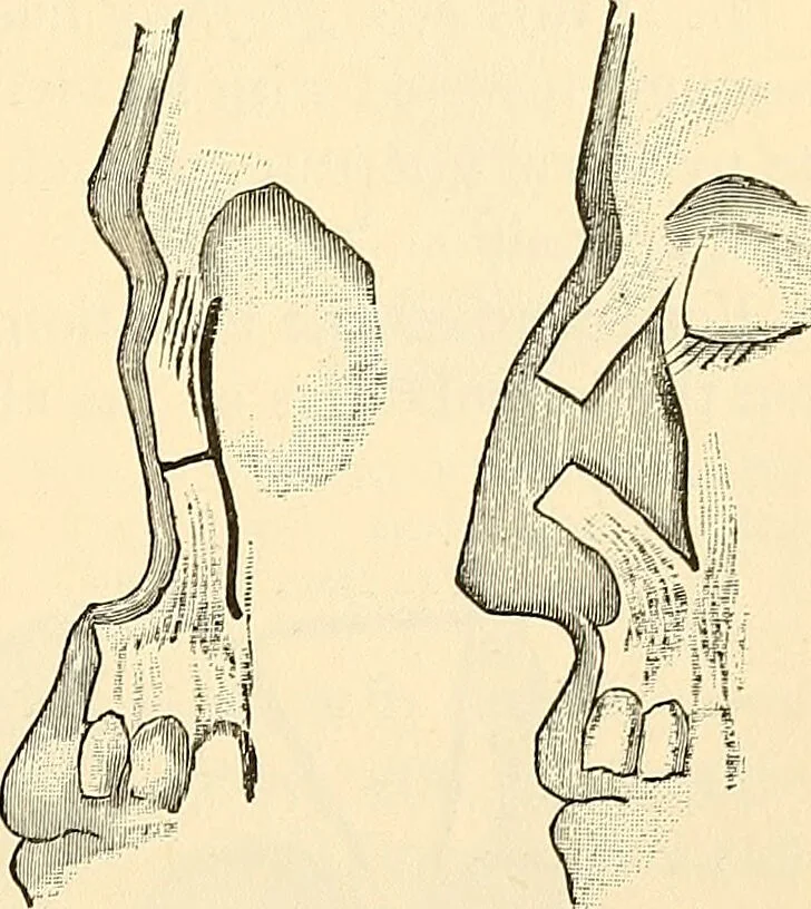 An illustration from Surgical technic; a text-book on operative surgery / by Fr. von Esmarch ... and E. Kowalzig ... translated by Professor Ludwig H. Grau ... and Willam N. Sullivan ... edited by Nicholas Senn ... With fourteen hundred and ninety-seven illustrations and fifteen colored plates., 1901, leaf 611