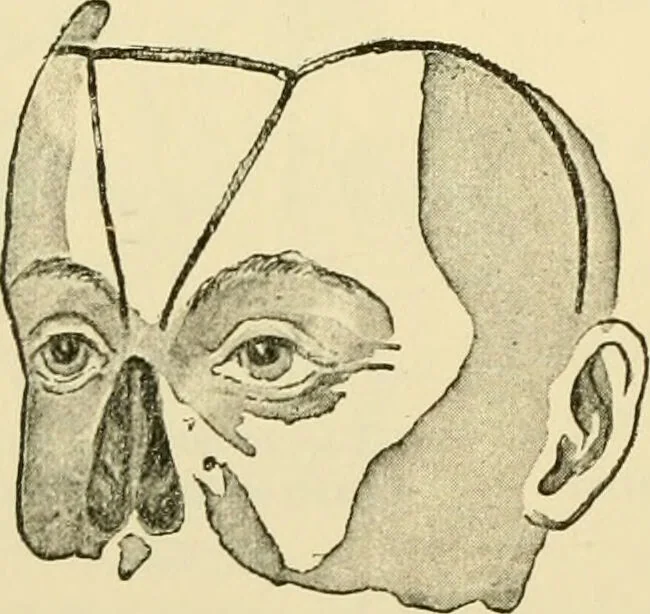 An illustration from Surgical technic; a text-book on operative surgery / by Fr. von Esmarch ... and E. Kowalzig ... translated by Professor Ludwig H. Grau ... and Willam N. Sullivan ... edited by Nicholas Senn ... With fourteen hundred and ninety-seven illustrations and fifteen colored plates., 1901, leaf 612