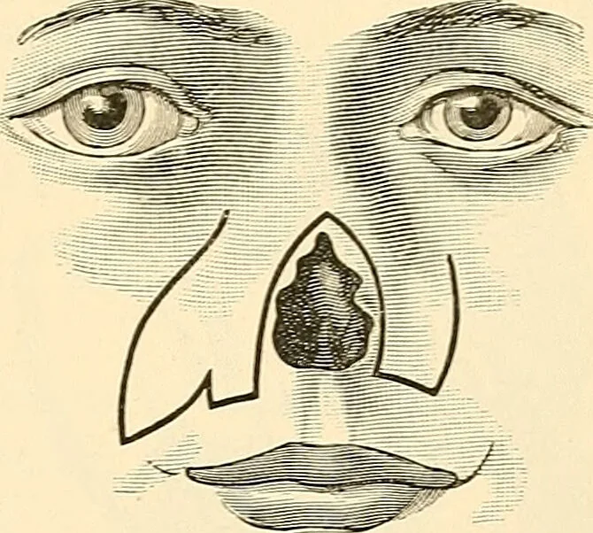 An illustration from Surgical technic; a text-book on operative surgery / by Fr. von Esmarch ... and E. Kowalzig ... translated by Professor Ludwig H. Grau ... and Willam N. Sullivan ... edited by Nicholas Senn ... With fourteen hundred and ninety-seven illustrations and fifteen colored plates., 1901, leaf 613