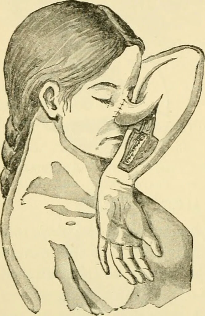 An illustration from Surgical technic; a text-book on operative surgery / by Fr. von Esmarch ... and E. Kowalzig ... translated by Professor Ludwig H. Grau ... and Willam N. Sullivan ... edited by Nicholas Senn ... With fourteen hundred and ninety-seven illustrations and fifteen colored plates., 1901, leaf 614