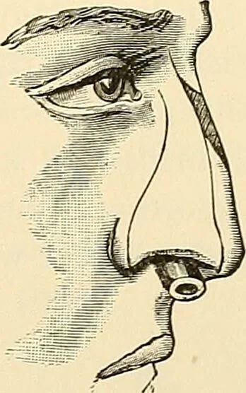 An illustration from Surgical technic; a text-book on operative surgery / by Fr. von Esmarch ... and E. Kowalzig ... translated by Professor Ludwig H. Grau ... and Willam N. Sullivan ... edited by Nicholas Senn ... With fourteen hundred and ninety-seven illustrations and fifteen colored plates., 1901, leaf 615