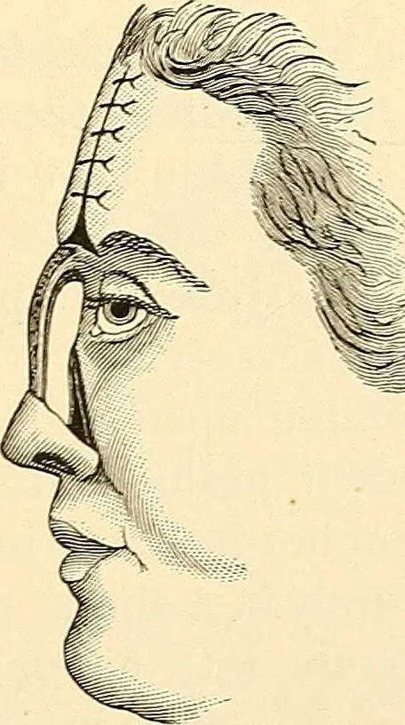 An illustration from Surgical technic; a text-book on operative surgery / by Fr. von Esmarch ... and E. Kowalzig ... translated by Professor Ludwig H. Grau ... and Willam N. Sullivan ... edited by Nicholas Senn ... With fourteen hundred and ninety-seven illustrations and fifteen colored plates., 1901, leaf 619