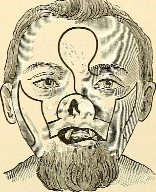 An illustration from Surgical technic; a text-book on operative surgery / by Fr. von Esmarch ... and E. Kowalzig ... translated by Professor Ludwig H. Grau ... and Willam N. Sullivan ... edited by Nicholas Senn ... With fourteen hundred and ninety-seven illustrations and fifteen colored plates., 1901, leaf 619