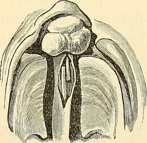 An illustration from Surgical technic; a text-book on operative surgery / by Fr. von Esmarch ... and E. Kowalzig ... translated by Professor Ludwig H. Grau ... and Willam N. Sullivan ... edited by Nicholas Senn ... With fourteen hundred and ninety-seven illustrations and fifteen colored plates., 1901, leaf 625