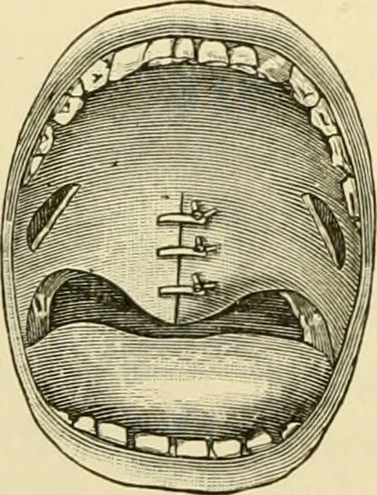 An illustration from Surgical technic; a text-book on operative surgery / by Fr. von Esmarch ... and E. Kowalzig ... translated by Professor Ludwig H. Grau ... and Willam N. Sullivan ... edited by Nicholas Senn ... With fourteen hundred and ninety-seven illustrations and fifteen colored plates., 1901, leaf 630