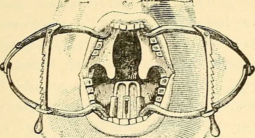 An illustration from Surgical technic; a text-book on operative surgery / by Fr. von Esmarch ... and E. Kowalzig ... translated by Professor Ludwig H. Grau ... and Willam N. Sullivan ... edited by Nicholas Senn ... With fourteen hundred and ninety-seven illustrations and fifteen colored plates., 1901, leaf 659