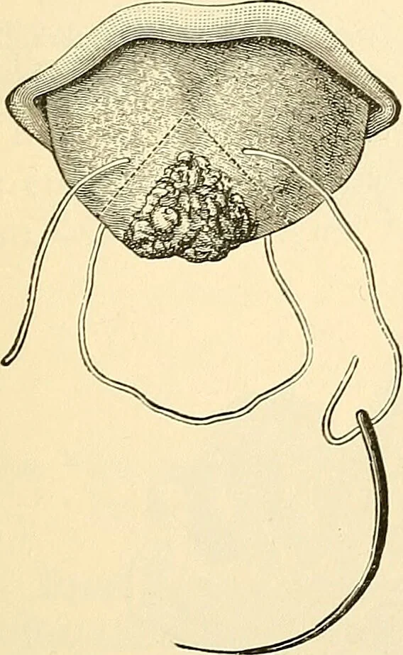 An illustration from Surgical technic; a text-book on operative surgery / by Fr. von Esmarch ... and E. Kowalzig ... translated by Professor Ludwig H. Grau ... and Willam N. Sullivan ... edited by Nicholas Senn ... With fourteen hundred and ninety-seven illustrations and fifteen colored plates., 1901, leaf 673