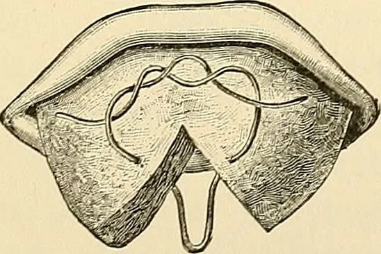 An illustration from Surgical technic; a text-book on operative surgery / by Fr. von Esmarch ... and E. Kowalzig ... translated by Professor Ludwig H. Grau ... and Willam N. Sullivan ... edited by Nicholas Senn ... With fourteen hundred and ninety-seven illustrations and fifteen colored plates., 1901, leaf 673