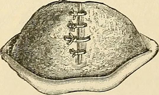 An illustration from Surgical technic; a text-book on operative surgery / by Fr. von Esmarch ... and E. Kowalzig ... translated by Professor Ludwig H. Grau ... and Willam N. Sullivan ... edited by Nicholas Senn ... With fourteen hundred and ninety-seven illustrations and fifteen colored plates., 1901, leaf 673
