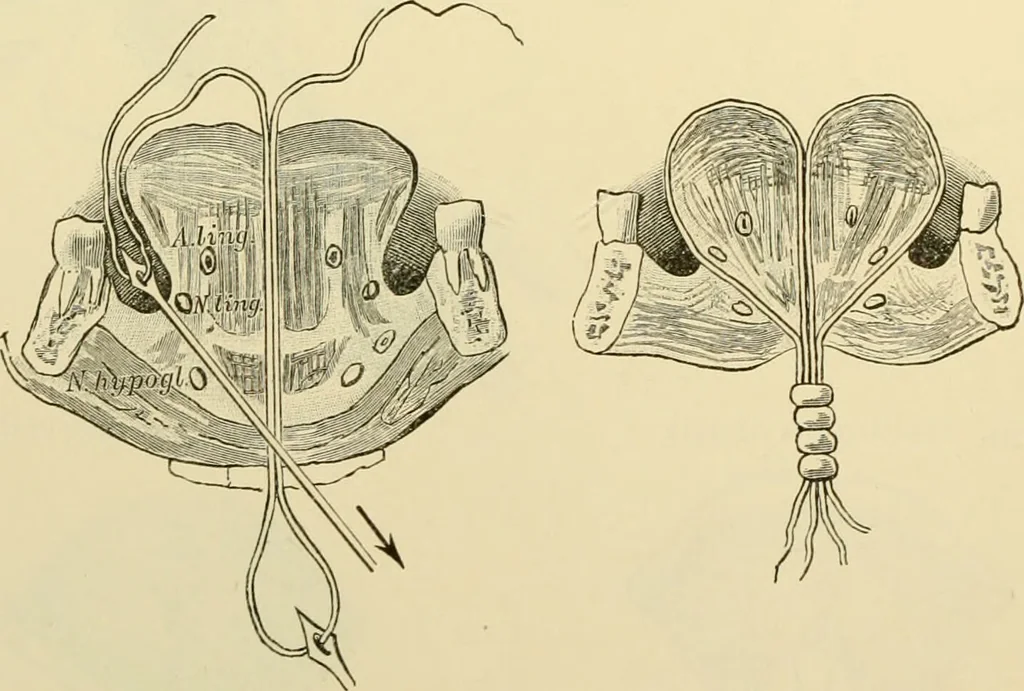An illustration from Surgical technic; a text-book on operative surgery / by Fr. von Esmarch ... and E. Kowalzig ... translated by Professor Ludwig H. Grau ... and Willam N. Sullivan ... edited by Nicholas Senn ... With fourteen hundred and ninety-seven illustrations and fifteen colored plates., 1901, leaf 674