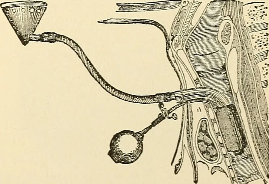 An illustration from Surgical technic; a text-book on operative surgery / by Fr. von Esmarch ... and E. Kowalzig ... translated by Professor Ludwig H. Grau ... and Willam N. Sullivan ... edited by Nicholas Senn ... With fourteen hundred and ninety-seven illustrations and fifteen colored plates., 1901, leaf 697