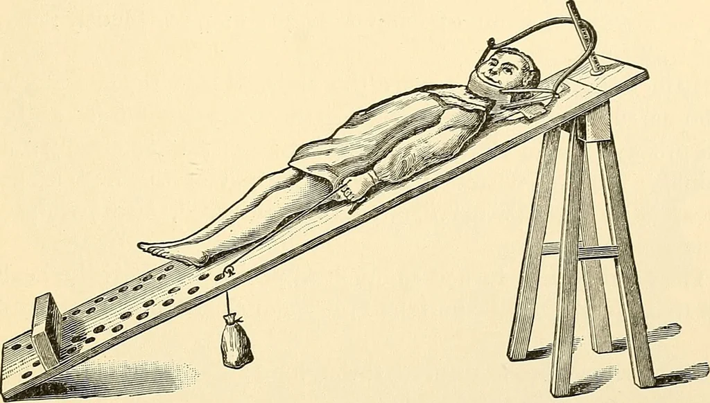 An illustration from Surgical technic; a text-book on operative surgery / by Fr. von Esmarch ... and E. Kowalzig ... translated by Professor Ludwig H. Grau ... and Willam N. Sullivan ... edited by Nicholas Senn ... With fourteen hundred and ninety-seven illustrations and fifteen colored plates., 1901, leaf 721