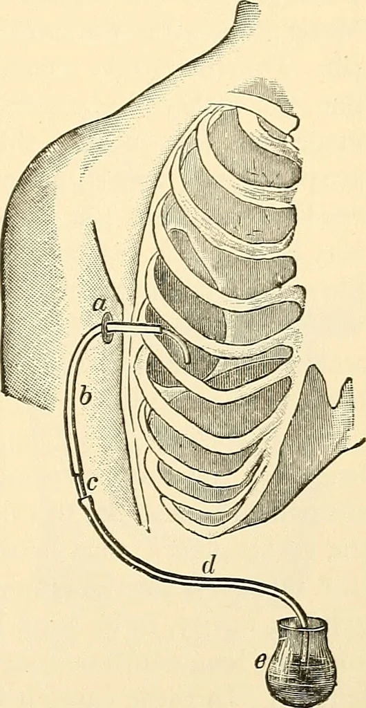 An illustration from Surgical technic; a text-book on operative surgery / by Fr. von Esmarch ... and E. Kowalzig ... translated by Professor Ludwig H. Grau ... and Willam N. Sullivan ... edited by Nicholas Senn ... With fourteen hundred and ninety-seven illustrations and fifteen colored plates., 1901, leaf 737