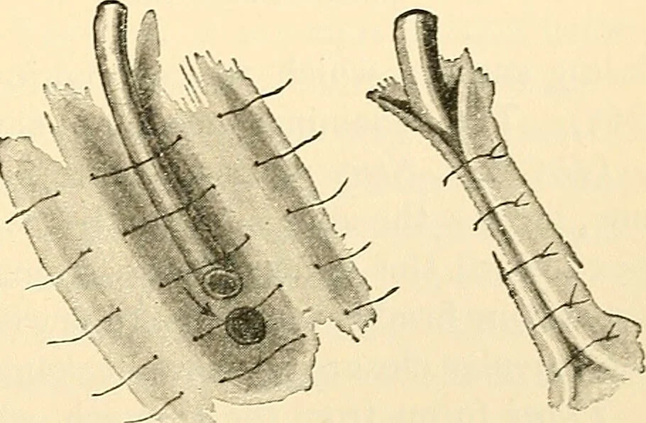 An illustration from Surgical technic; a text-book on operative surgery / by Fr. von Esmarch ... and E. Kowalzig ... translated by Professor Ludwig H. Grau ... and Willam N. Sullivan ... edited by Nicholas Senn ... With fourteen hundred and ninety-seven illustrations and fifteen colored plates., 1901, leaf 759
