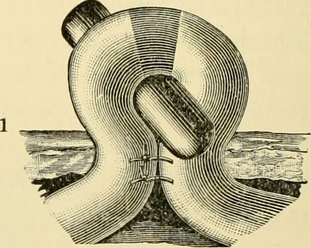 An illustration from Surgical technic; a text-book on operative surgery / by Fr. von Esmarch ... and E. Kowalzig ... translated by Professor Ludwig H. Grau ... and Willam N. Sullivan ... edited by Nicholas Senn ... With fourteen hundred and ninety-seven illustrations and fifteen colored plates., 1901, leaf 776