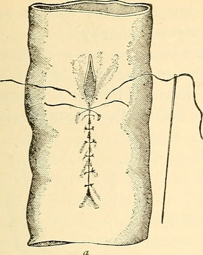 An illustration from Surgical technic; a text-book on operative surgery / by Fr. von Esmarch ... and E. Kowalzig ... translated by Professor Ludwig H. Grau ... and Willam N. Sullivan ... edited by Nicholas Senn ... With fourteen hundred and ninety-seven illustrations and fifteen colored plates., 1901, leaf 779