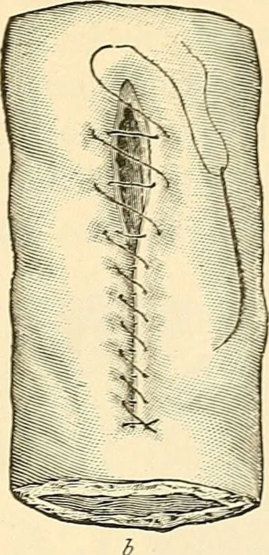 An illustration from Surgical technic; a text-book on operative surgery / by Fr. von Esmarch ... and E. Kowalzig ... translated by Professor Ludwig H. Grau ... and Willam N. Sullivan ... edited by Nicholas Senn ... With fourteen hundred and ninety-seven illustrations and fifteen colored plates., 1901, leaf 779