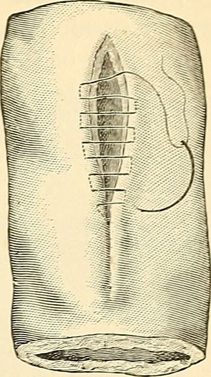 An illustration from Surgical technic; a text-book on operative surgery / by Fr. von Esmarch ... and E. Kowalzig ... translated by Professor Ludwig H. Grau ... and Willam N. Sullivan ... edited by Nicholas Senn ... With fourteen hundred and ninety-seven illustrations and fifteen colored plates., 1901, leaf 779