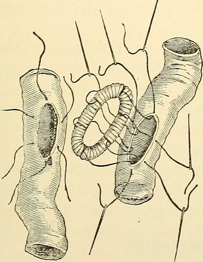 An illustration from Surgical technic; a text-book on operative surgery / by Fr. von Esmarch ... and E. Kowalzig ... translated by Professor Ludwig H. Grau ... and Willam N. Sullivan ... edited by Nicholas Senn ... With fourteen hundred and ninety-seven illustrations and fifteen colored plates., 1901, leaf 781