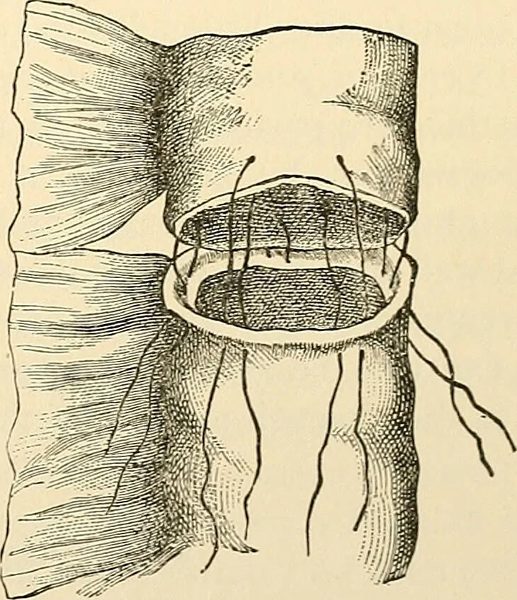 An illustration from Surgical technic; a text-book on operative surgery / by Fr. von Esmarch ... and E. Kowalzig ... translated by Professor Ludwig H. Grau ... and Willam N. Sullivan ... edited by Nicholas Senn ... With fourteen hundred and ninety-seven illustrations and fifteen colored plates., 1901, leaf 781