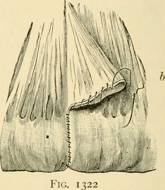 An illustration from Surgical technic; a text-book on operative surgery / by Fr. von Esmarch ... and E. Kowalzig ... translated by Professor Ludwig H. Grau ... and Willam N. Sullivan ... edited by Nicholas Senn ... With fourteen hundred and ninety-seven illustrations and fifteen colored plates., 1901, leaf 784