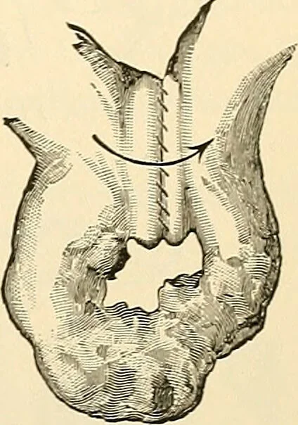 An illustration from Surgical technic; a text-book on operative surgery / by Fr. von Esmarch ... and E. Kowalzig ... translated by Professor Ludwig H. Grau ... and Willam N. Sullivan ... edited by Nicholas Senn ... With fourteen hundred and ninety-seven illustrations and fifteen colored plates., 1901, leaf 785