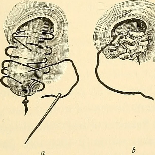 An illustration from Surgical technic; a text-book on operative surgery / by Fr. von Esmarch ... and E. Kowalzig ... translated by Professor Ludwig H. Grau ... and Willam N. Sullivan ... edited by Nicholas Senn ... With fourteen hundred and ninety-seven illustrations and fifteen colored plates., 1901, leaf 801