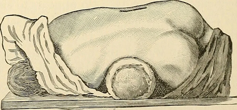 An illustration from Surgical technic; a text-book on operative surgery / by Fr. von Esmarch ... and E. Kowalzig ... translated by Professor Ludwig H. Grau ... and Willam N. Sullivan ... edited by Nicholas Senn ... With fourteen hundred and ninety-seven illustrations and fifteen colored plates., 1901, leaf 817