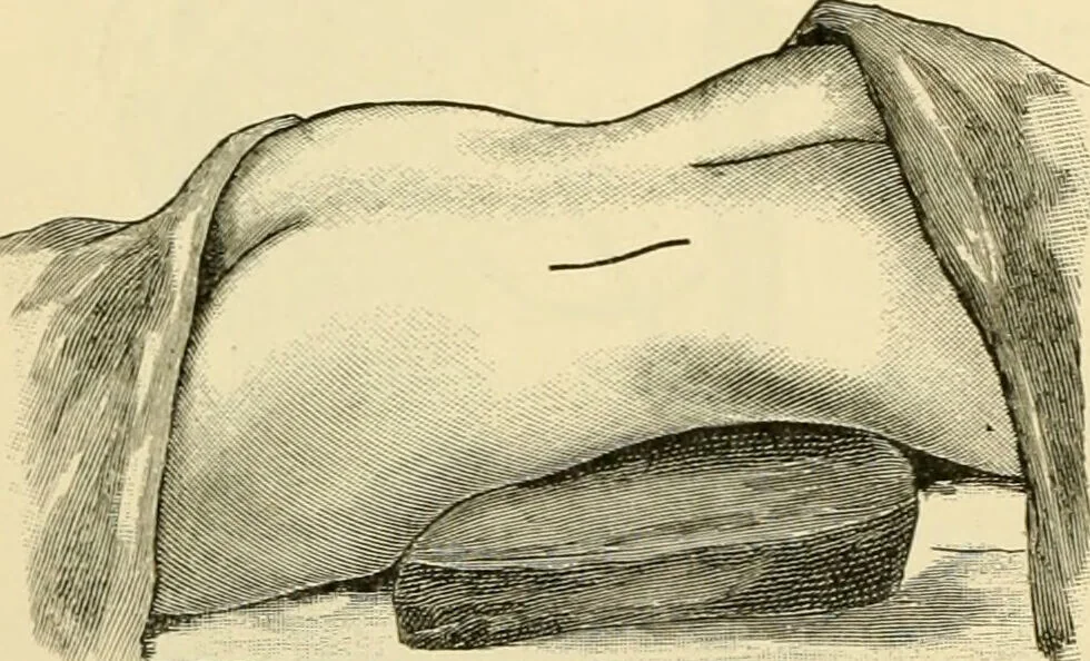 An illustration from Surgical technic; a text-book on operative surgery / by Fr. von Esmarch ... and E. Kowalzig ... translated by Professor Ludwig H. Grau ... and Willam N. Sullivan ... edited by Nicholas Senn ... With fourteen hundred and ninety-seven illustrations and fifteen colored plates., 1901, leaf 818